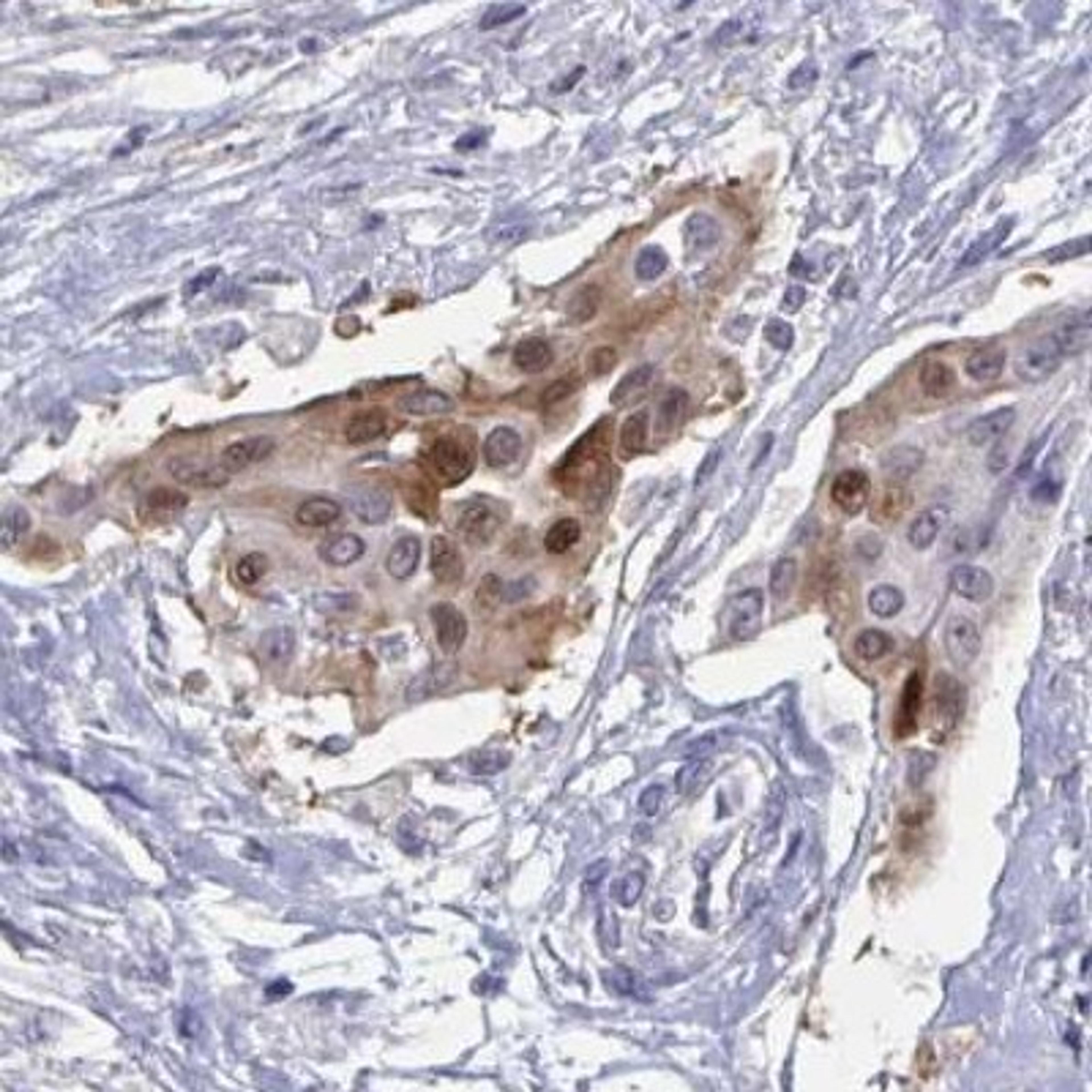 Immunohistochemistry: ZNF784 Antibody [NBP2-31791] - cervical cancer