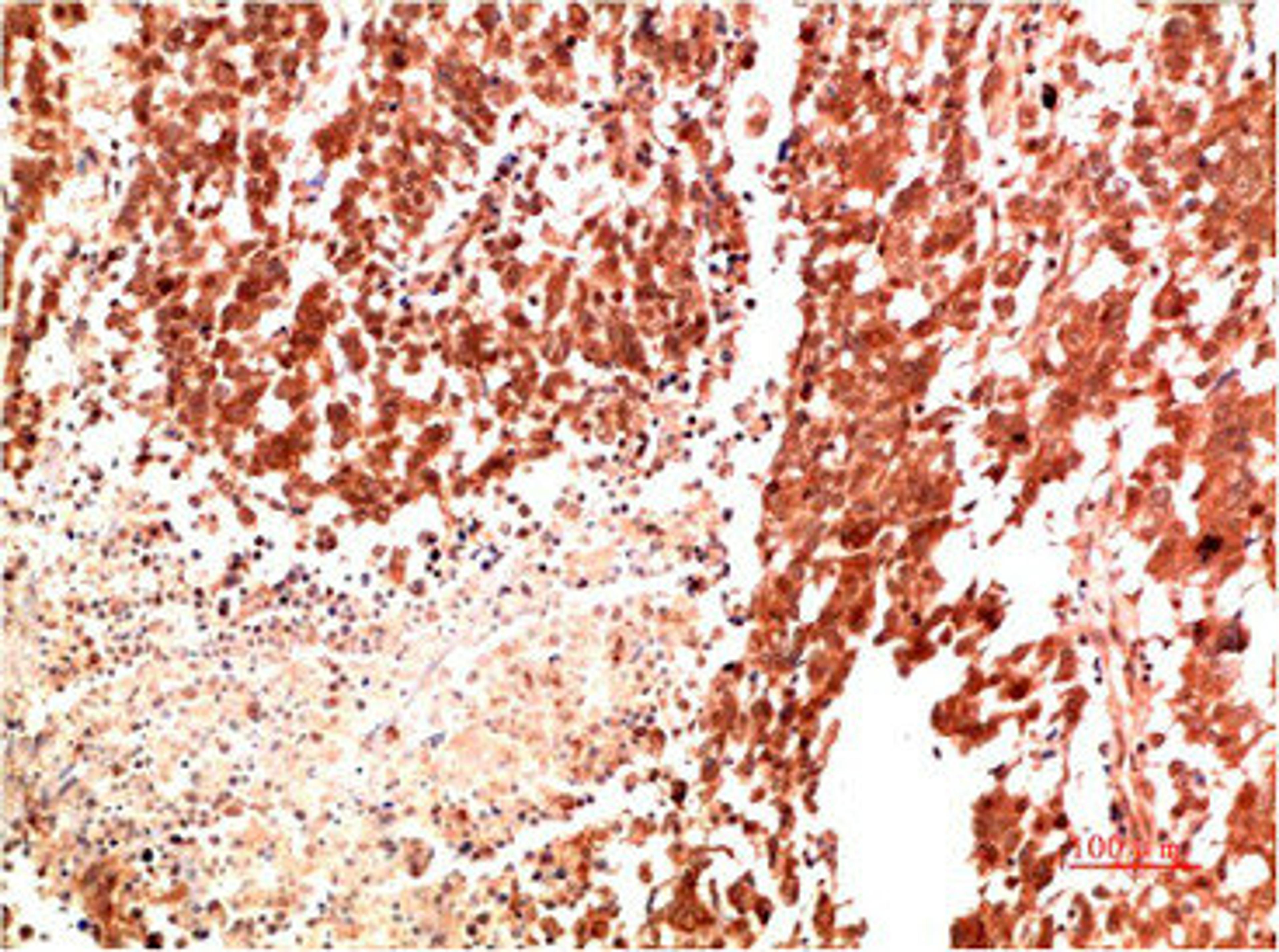 Immunohistochemical analysis of paraffin-embedded Human Lung Carcinoma Tissue using Met Rabbit pAb diluted at 1:500.