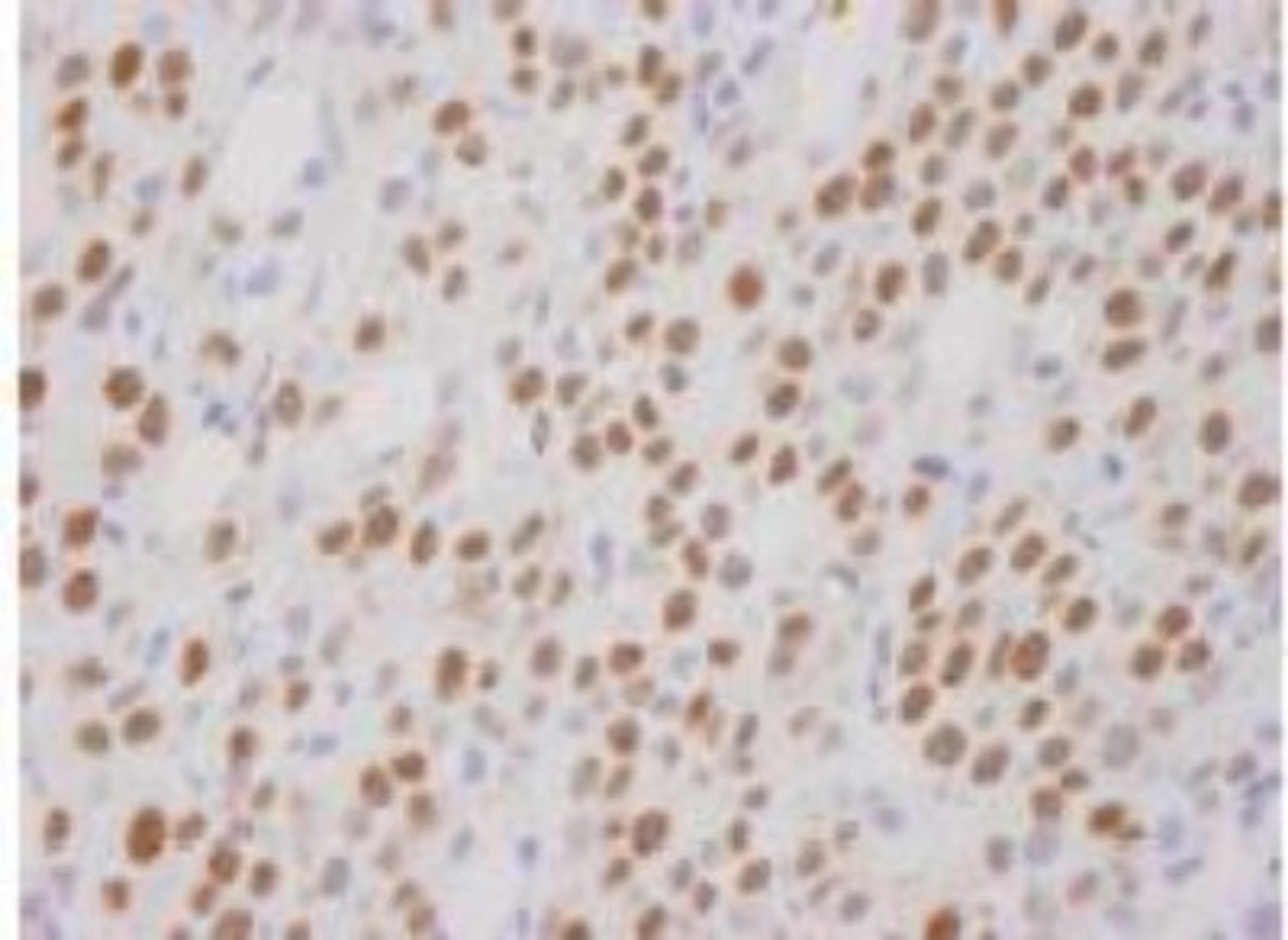 Immunohistochemistry-Paraffin: CoREST Antibody [NB600-240] - Human metastatic bone marrow. Affinity purified rabbit anti-CoREST used at a dilution of 1:250. Detection: DAB staining using Immunohistochemistry Accessory Kit