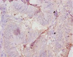 Immunohistochemistry of paraffin-embedded human colon cancer using CSB-PA001666YA01MO at dilution of 1:10