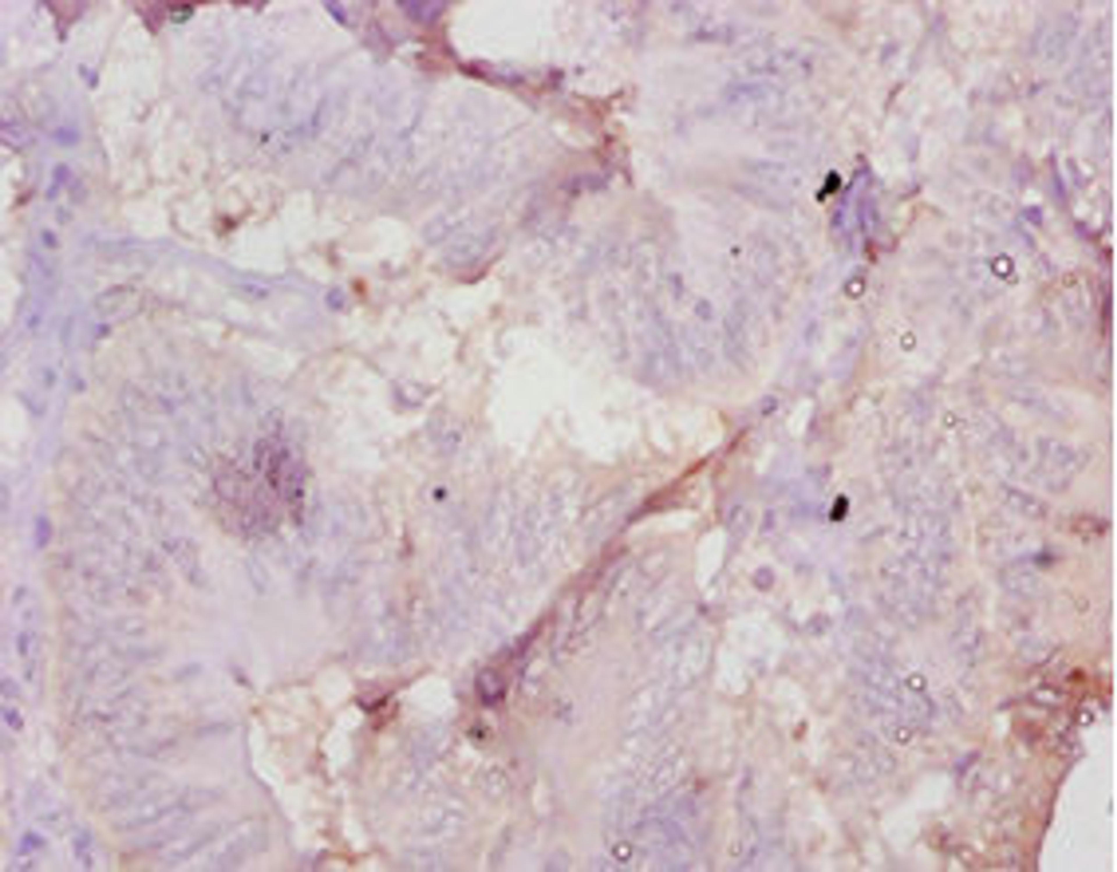 Immunohistochemistry of paraffin-embedded human colon cancer using CSB-PA001666YA01MO at dilution of 1:10