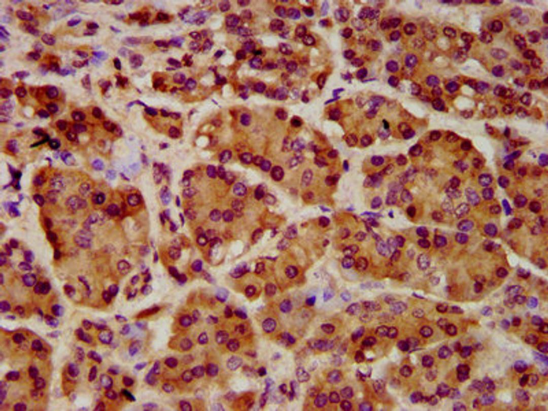 IHC image of CSB-PA836246LA01HU diluted at 1:1000 and staining in paraffin-embedded human pancreatic cancer performed on a Leica BondTM system. After dewaxing and hydration, antigen retrieval was mediated by high pressure in a citrate buffer (pH 6.0). Section was blocked with 10% normal goat serum 30min at RT. Then primary antibody (1% BSA) was incubated at 4°C overnight. The primary is detected by a biotinylated secondary antibody and visualized using an HRP conjugated SP system.