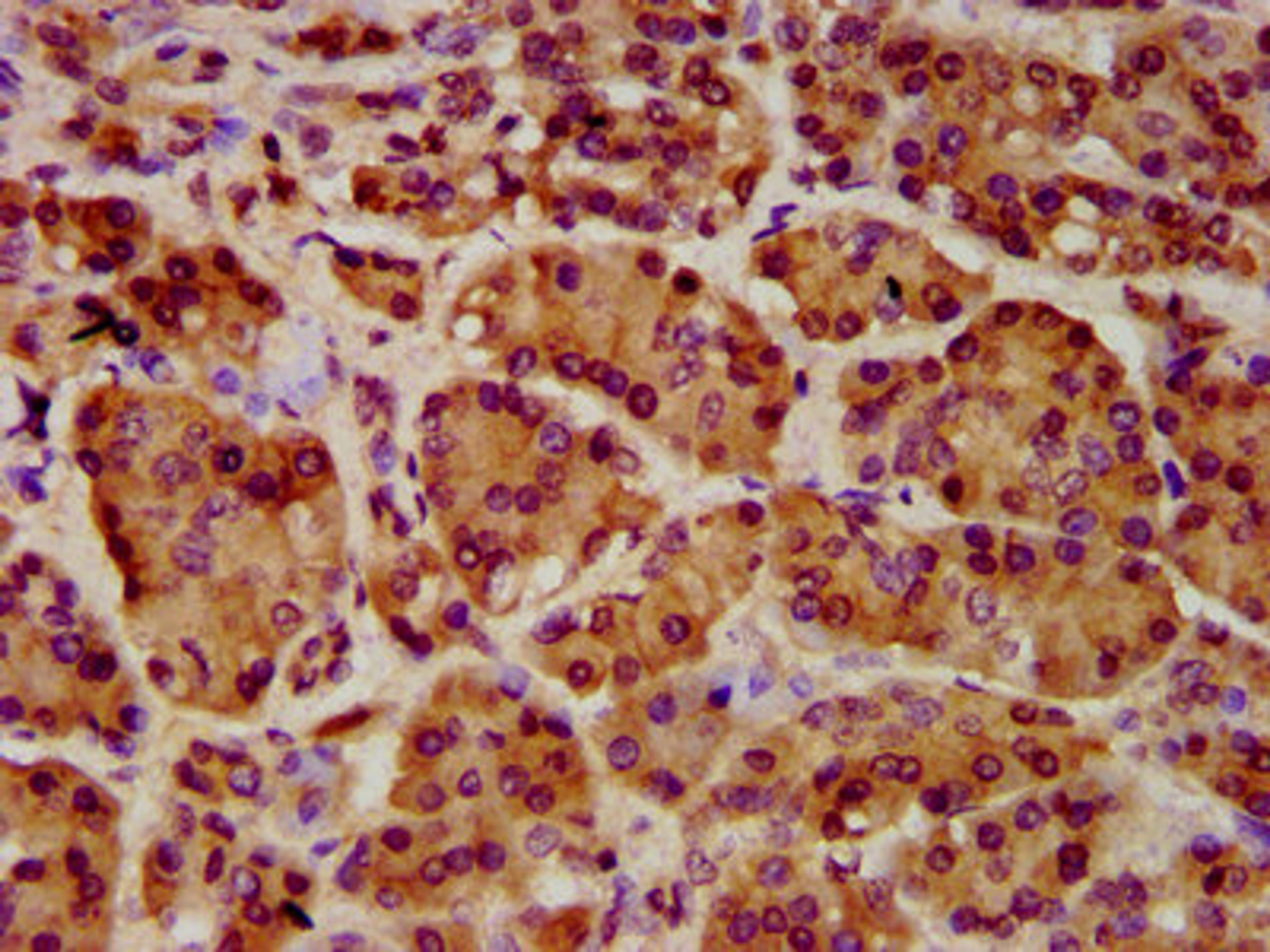 IHC image of CSB-PA836246LA01HU diluted at 1:1000 and staining in paraffin-embedded human pancreatic cancer performed on a Leica BondTM system. After dewaxing and hydration, antigen retrieval was mediated by high pressure in a citrate buffer (pH 6.0). Section was blocked with 10% normal goat serum 30min at RT. Then primary antibody (1% BSA) was incubated at 4°C overnight. The primary is detected by a biotinylated secondary antibody and visualized using an HRP conjugated SP system.