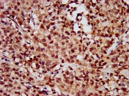 IHC image of CSB-PA010418OA56nhibHU diluted at 1: 10 and staining in paraffin-embedded human ovarian cancer performed on a Leica BondTM system. After dewaxing and hydration, antigen retrieval was mediated by high pressure in a citrate buffer (pH 6.0). Section was blocked with 10% normal goat serum 30min at RT. Then primary antibody (1% BSA) was incubated at 4°C overnight. The primary is detected by a biotinylated secondary antibody and visualized using an HRP conjugated SP system.