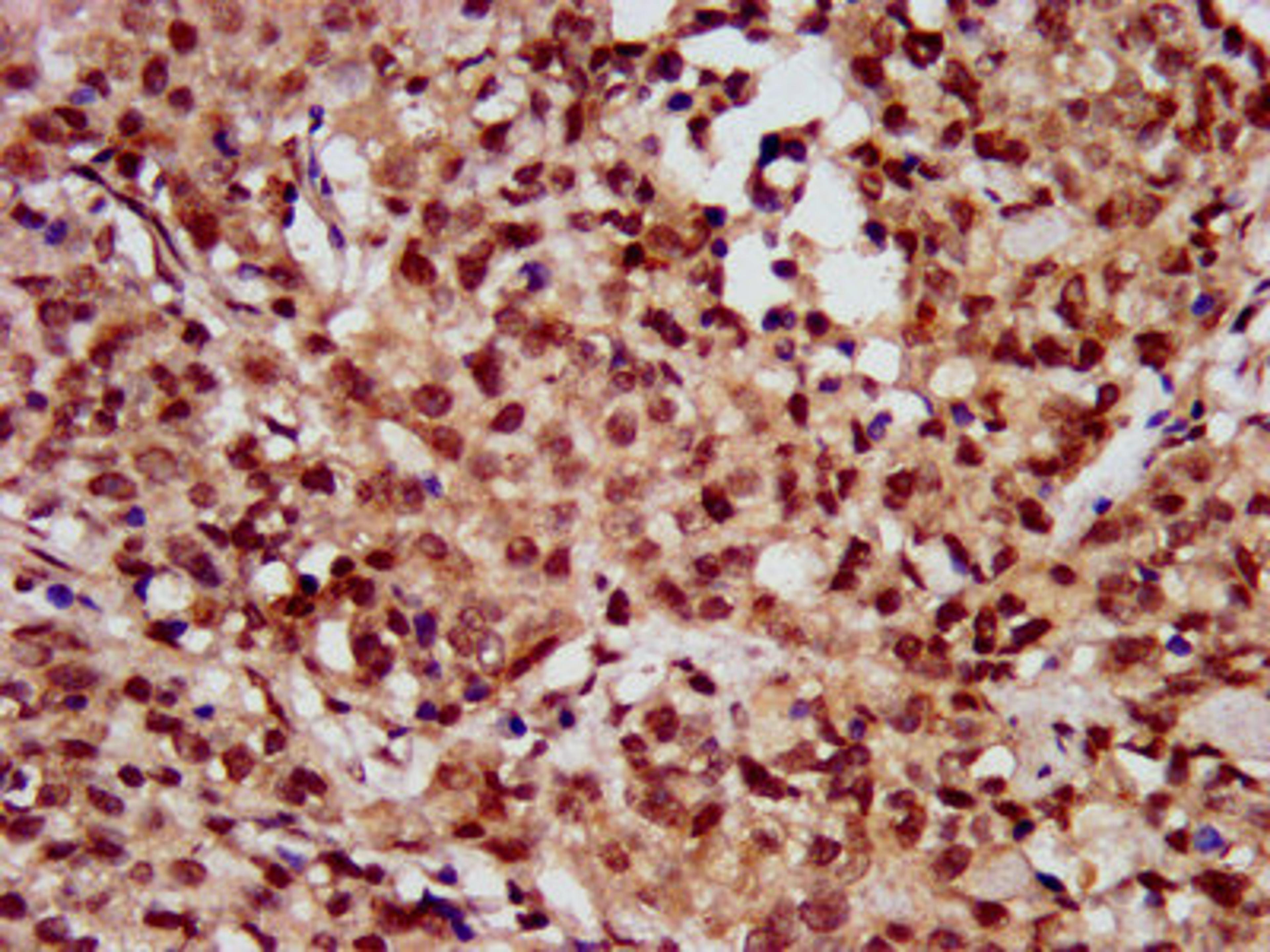 IHC image of CSB-PA010418OA56nhibHU diluted at 1: 10 and staining in paraffin-embedded human ovarian cancer performed on a Leica BondTM system. After dewaxing and hydration, antigen retrieval was mediated by high pressure in a citrate buffer (pH 6.0). Section was blocked with 10% normal goat serum 30min at RT. Then primary antibody (1% BSA) was incubated at 4°C overnight. The primary is detected by a biotinylated secondary antibody and visualized using an HRP conjugated SP system.