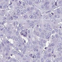 Immunohistochemistry: C7orf61 Antibody [NBP2-32540] - liver cancer