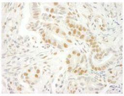 Immunohistochemistry-Paraffin: U2AF35 Antibody [NBP1-19120] - FFPE section of human stomach carcinoma.  Antibody used at a dilution of 1:250.