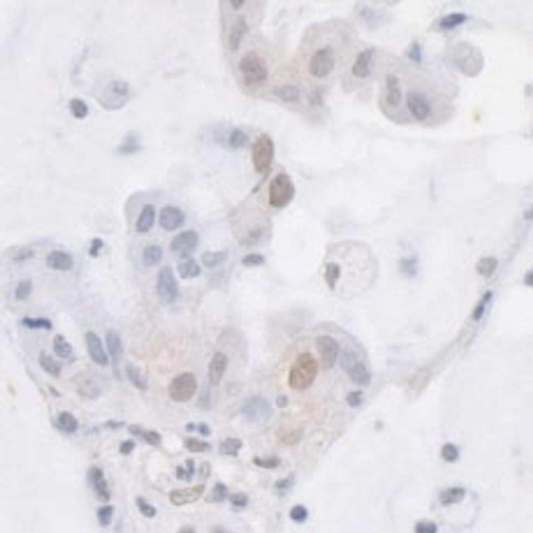 Detection of human ATRX by immunohistochemistry.