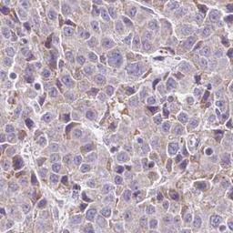 Immunohistochemistry: PPAP2C Antibody [NBP2-31607] - liver cancer