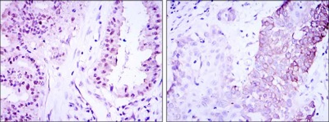 Immunohistochemistry: TORC3/CRTC3 Antibody (5G9) [NBP2-37635] - Immunohistochemical analysis of paraffin-embedded lung cancer (left) and esophagus cancer (right) using CRTC3 mouse mAb with DAB staining.