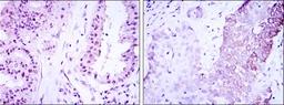 Immunohistochemistry: TORC3/CRTC3 Antibody (5G9) [NBP2-37635] - Immunohistochemical analysis of paraffin-embedded lung cancer (left) and esophagus cancer (right) using CRTC3 mouse mAb with DAB staining.