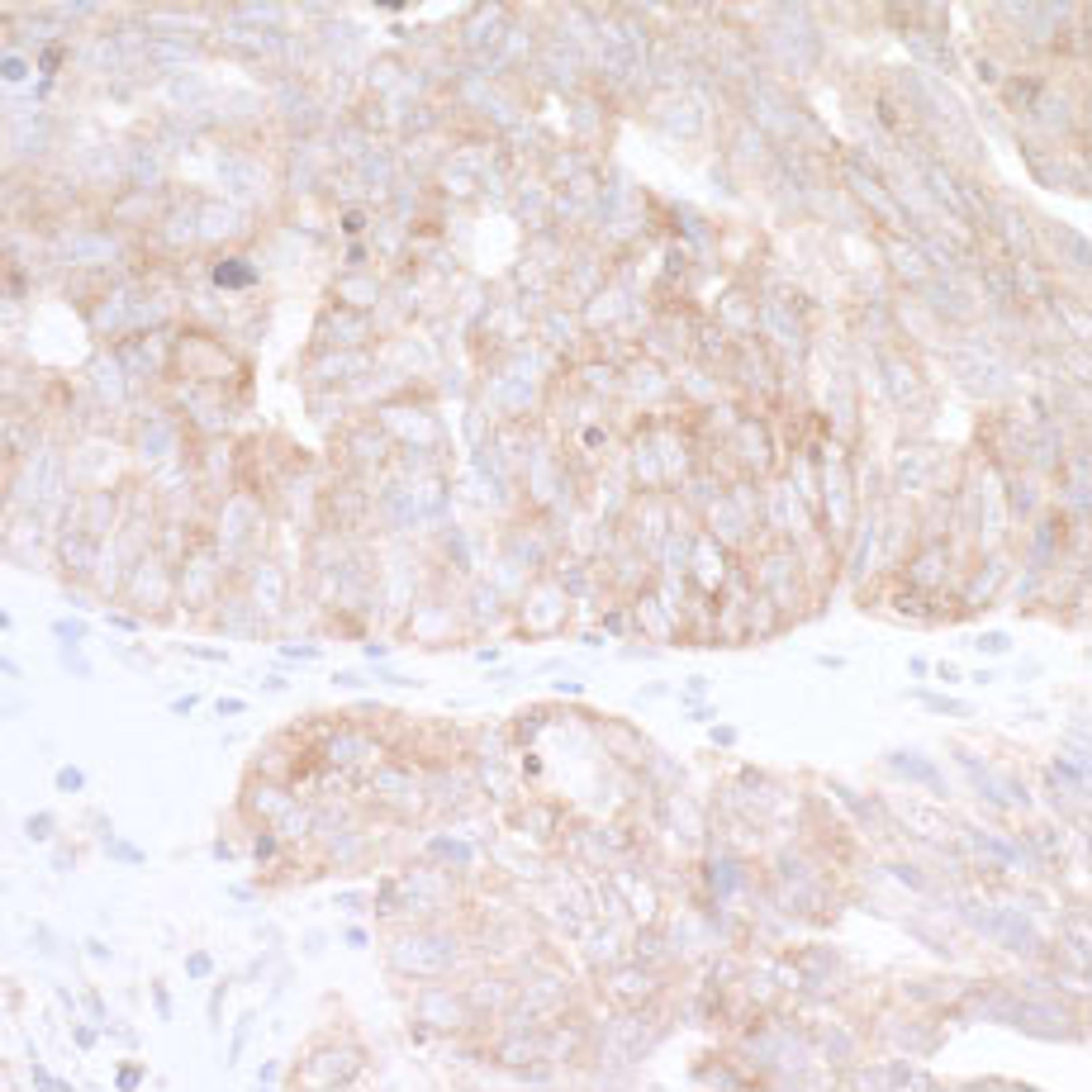 Detection of human CAD by immunohistochemistry.