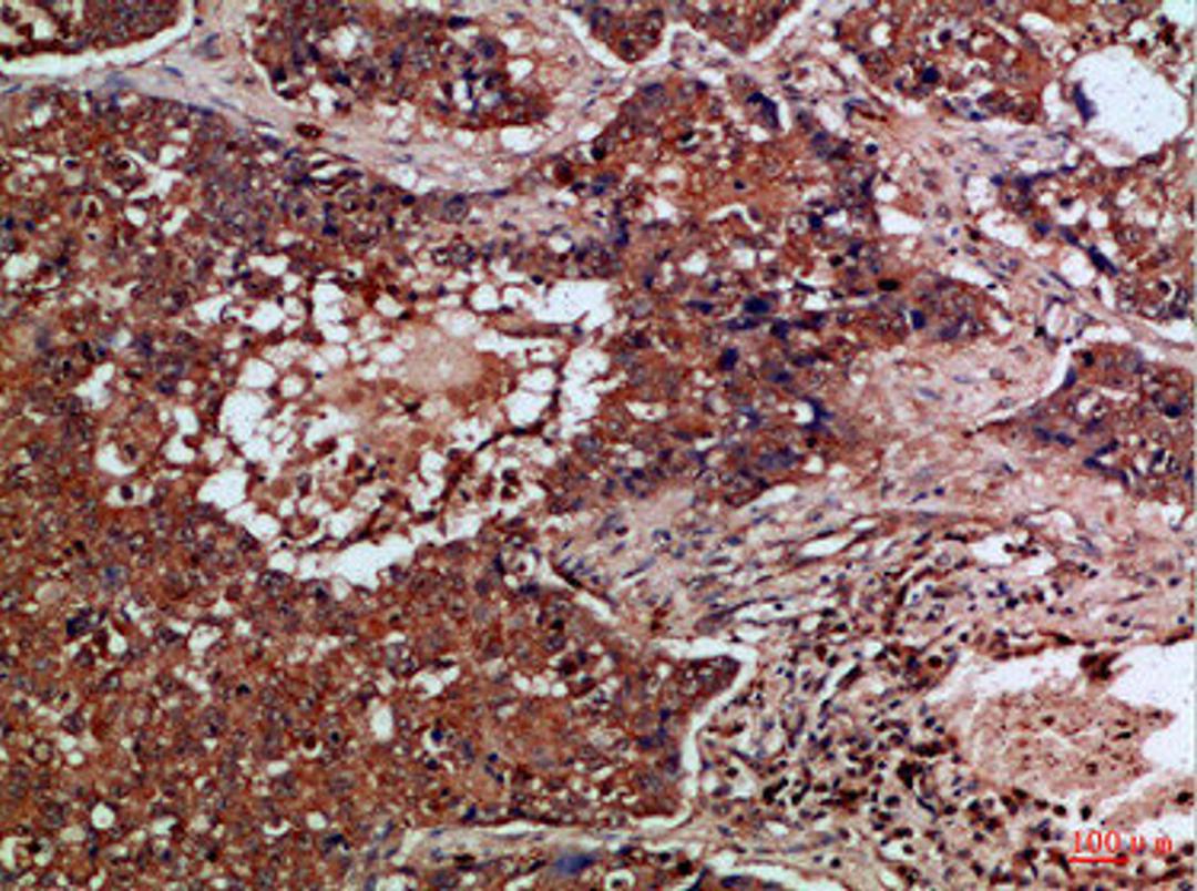 Immunohistochemical analysis of paraffin-embedded Human-lung-cancer, antibody was diluted at 1:100
