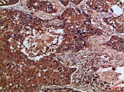 Immunohistochemical analysis of paraffin-embedded Human-lung-cancer, antibody was diluted at 1:100