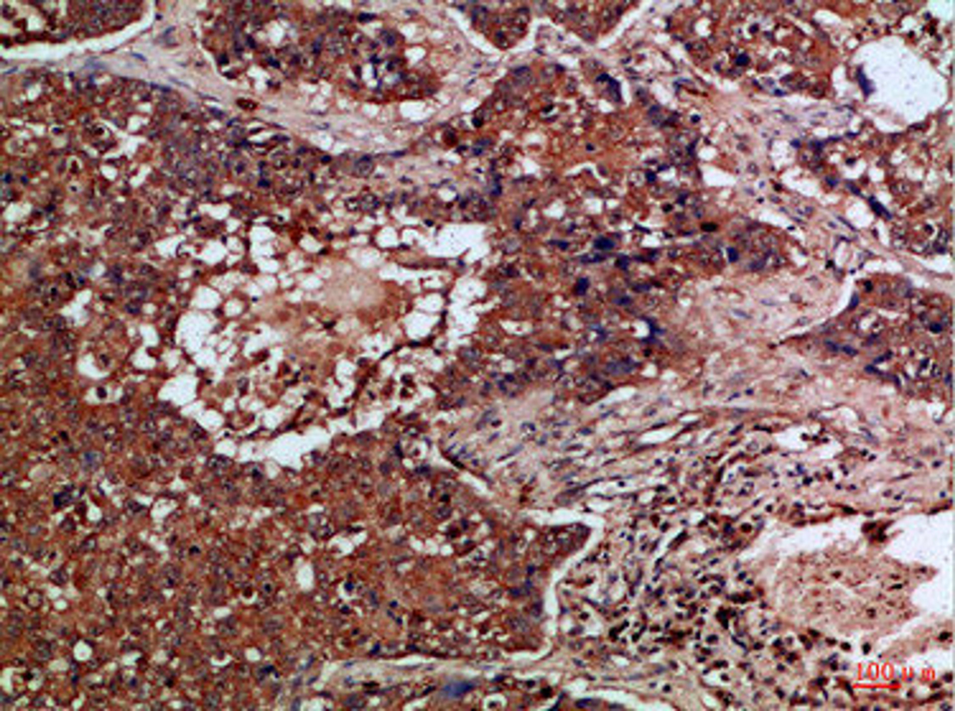 Immunohistochemical analysis of paraffin-embedded Human-lung-cancer, antibody was diluted at 1:100