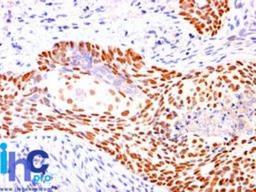 Immunohistochemistry-Paraffin: p40 (p63 delta) Antibody [NBP2-29467] - Formalin-fixed, paraffin-embedded human lung squamous cell carcinoma stained with p40 antibody (1:200), peroxidase-conjugate and DAB chromogen. Note nuclear staining.