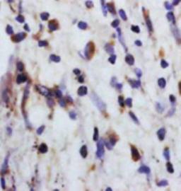 Paraffin-embedded human colon carcinoma fixed with 4% paraformaldehyde. Antigen retrieval by boiling with citrate buffer. Blocking buffer is goat serum (37 degrees for 20 min.). CCP antibody at 1:200 dilution with overnight incubation at 4 degrees