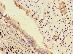 Immunohistochemistry of paraffin-embedded human lung cancer using CSB-PA018415LA01HU at dilution of 1:100