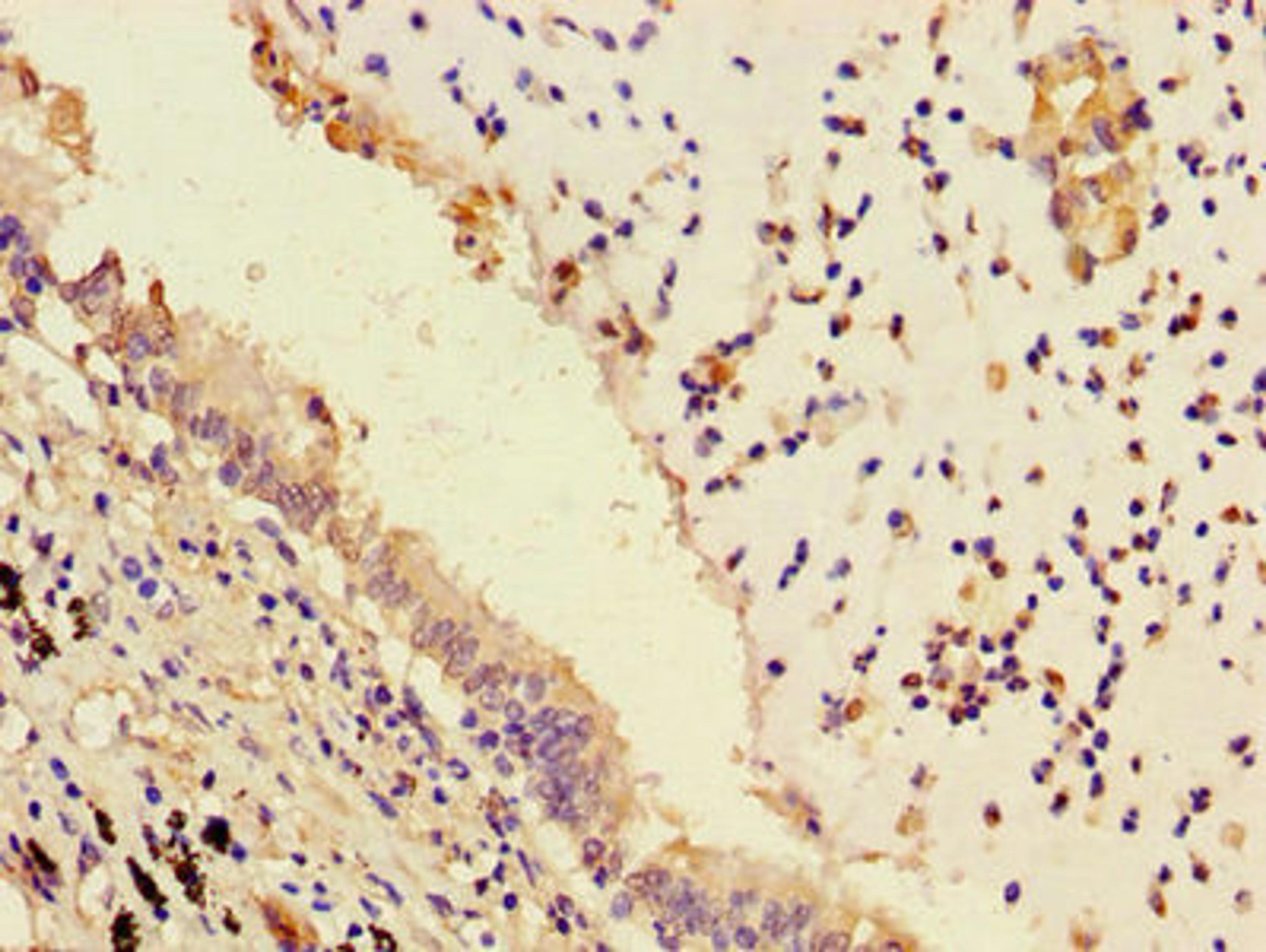 Immunohistochemistry of paraffin-embedded human lung cancer using CSB-PA018415LA01HU at dilution of 1:100