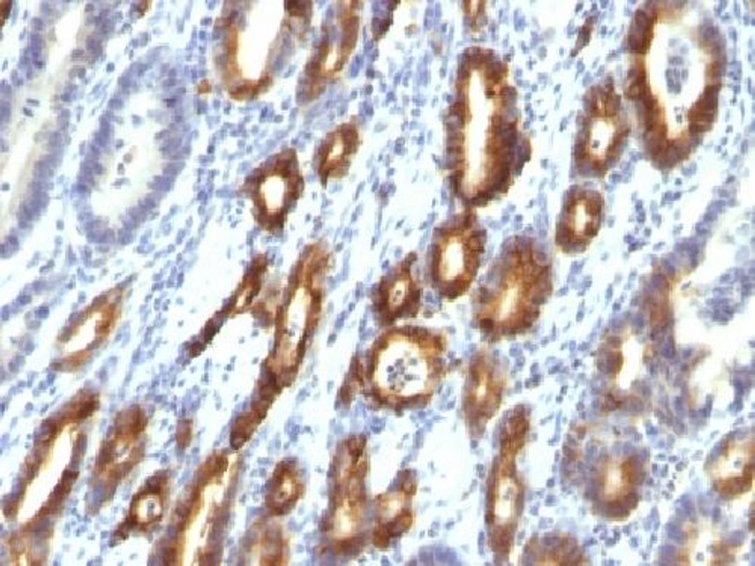 Immunohistochemical staining of human Gastric Carcinoma tissue using MUC6 antibody