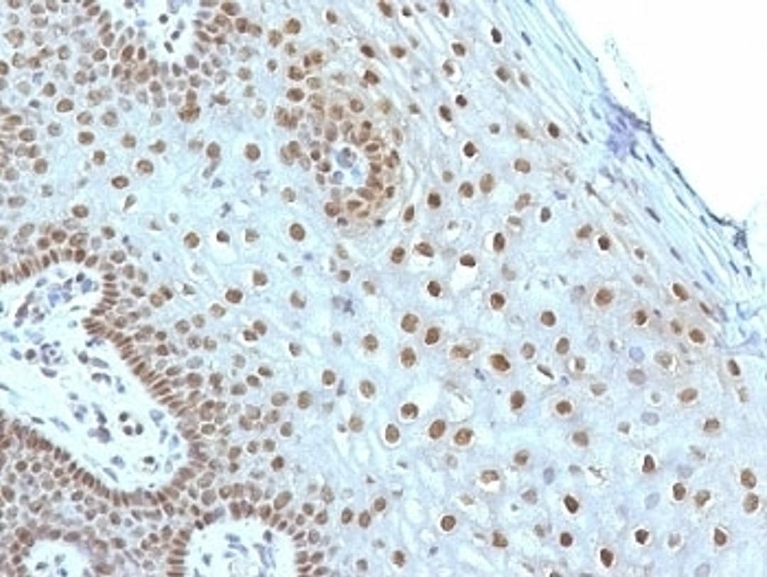 Formalin-fixed, paraffin-embedded human cervical carcinoma stained with c-Myc antibody (MYC275).