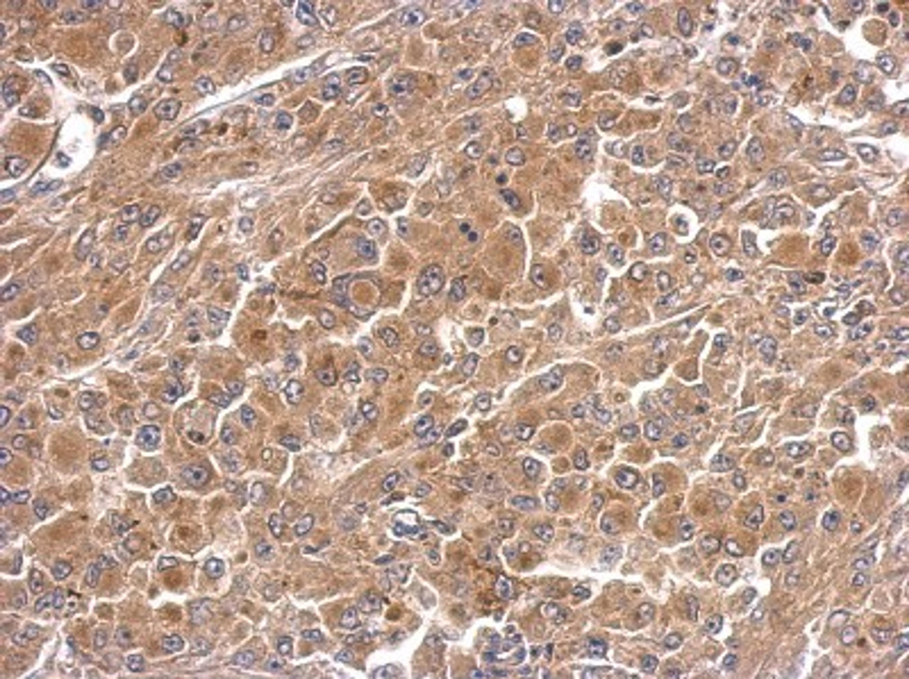 Immunohistochemistry-Paraffin: PAK6 Antibody [NBP2-19685] - Immunohistochemical analysis of paraffin-embedded HeLa xenograft, using antibody at 1:500 dilution.