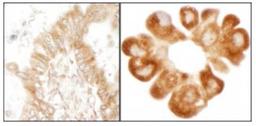 Immunohistochemistry-Paraffin: RPL7 Antibody [NB100-2269] - Human lung carcinoma and bronchioalveolar   carcinoma pleural effusion.