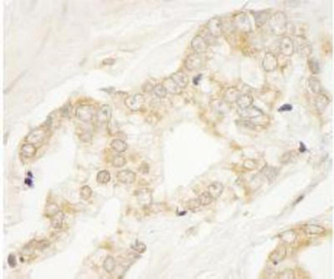 Immunohistochemistry-Paraffin: ARFGEF1 Antibody [NB100-55257] - Section of human prostate carcinoma. Antibody: Affinity purified rabbit anti-BIG1/ARFGEF1 used at a dilution of 1:250. Detection: DAB staining using Immunohistochemistry Accessory Kit. Epitope Retrieval Buffer-High pH was substituted for Epitope Retrieval Buffer-Reduced pH.