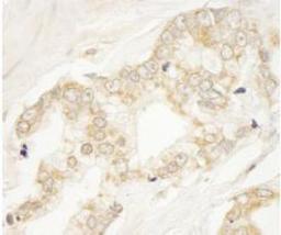 Immunohistochemistry-Paraffin: ARFGEF1 Antibody [NB100-55257] - Section of human prostate carcinoma. Antibody: Affinity purified rabbit anti-BIG1/ARFGEF1 used at a dilution of 1:250. Detection: DAB staining using Immunohistochemistry Accessory Kit. Epitope Retrieval Buffer-High pH was substituted for Epitope Retrieval Buffer-Reduced pH.