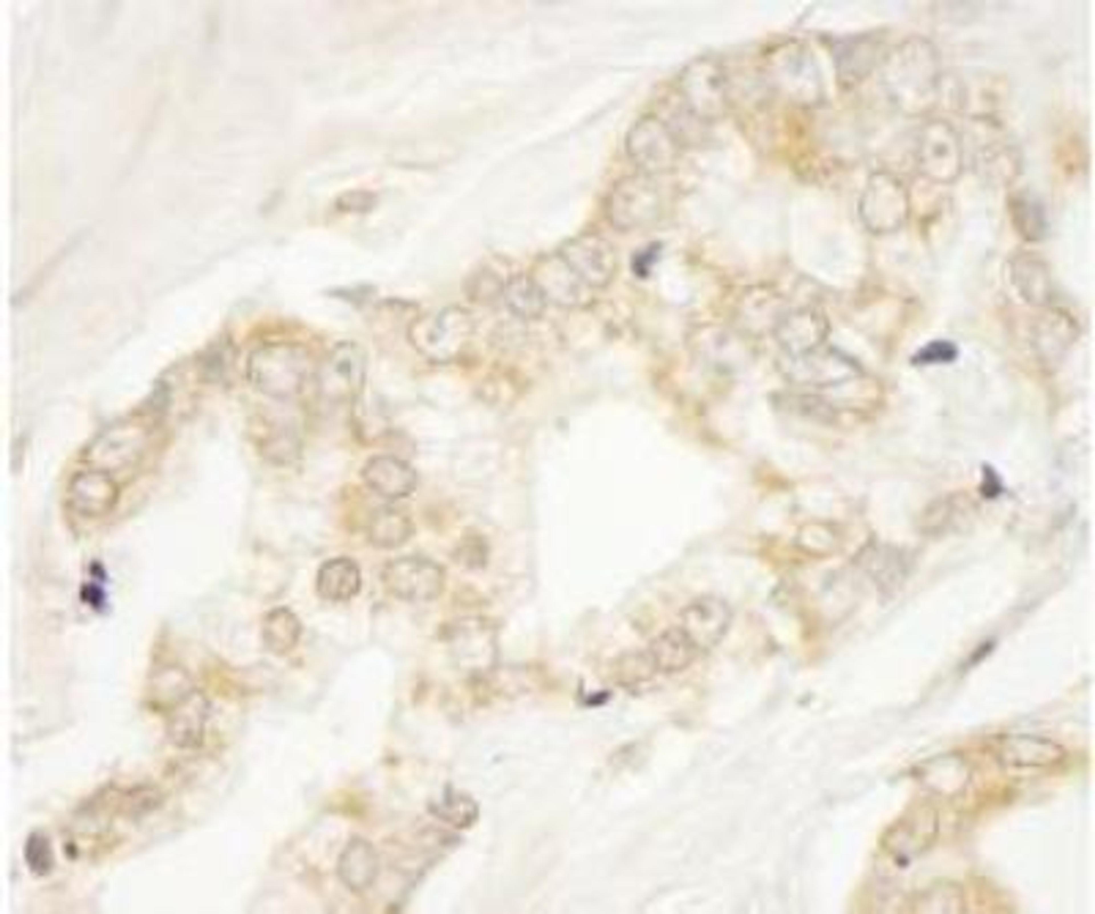 Immunohistochemistry-Paraffin: ARFGEF1 Antibody [NB100-55257] - Section of human prostate carcinoma. Antibody: Affinity purified rabbit anti-BIG1/ARFGEF1 used at a dilution of 1:250. Detection: DAB staining using Immunohistochemistry Accessory Kit. Epitope Retrieval Buffer-High pH was substituted for Epitope Retrieval Buffer-Reduced pH.