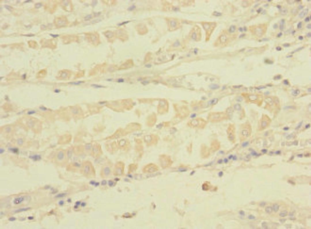 Immunohistochemistry of paraffin-embedded human gastric cancer using CSB-PA839859LA01HU at dilution of 1:100