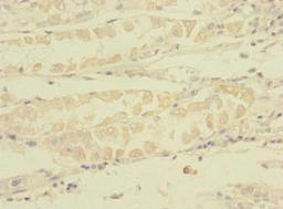 Immunohistochemistry of paraffin-embedded human gastric cancer using CSB-PA839859LA01HU at dilution of 1:100