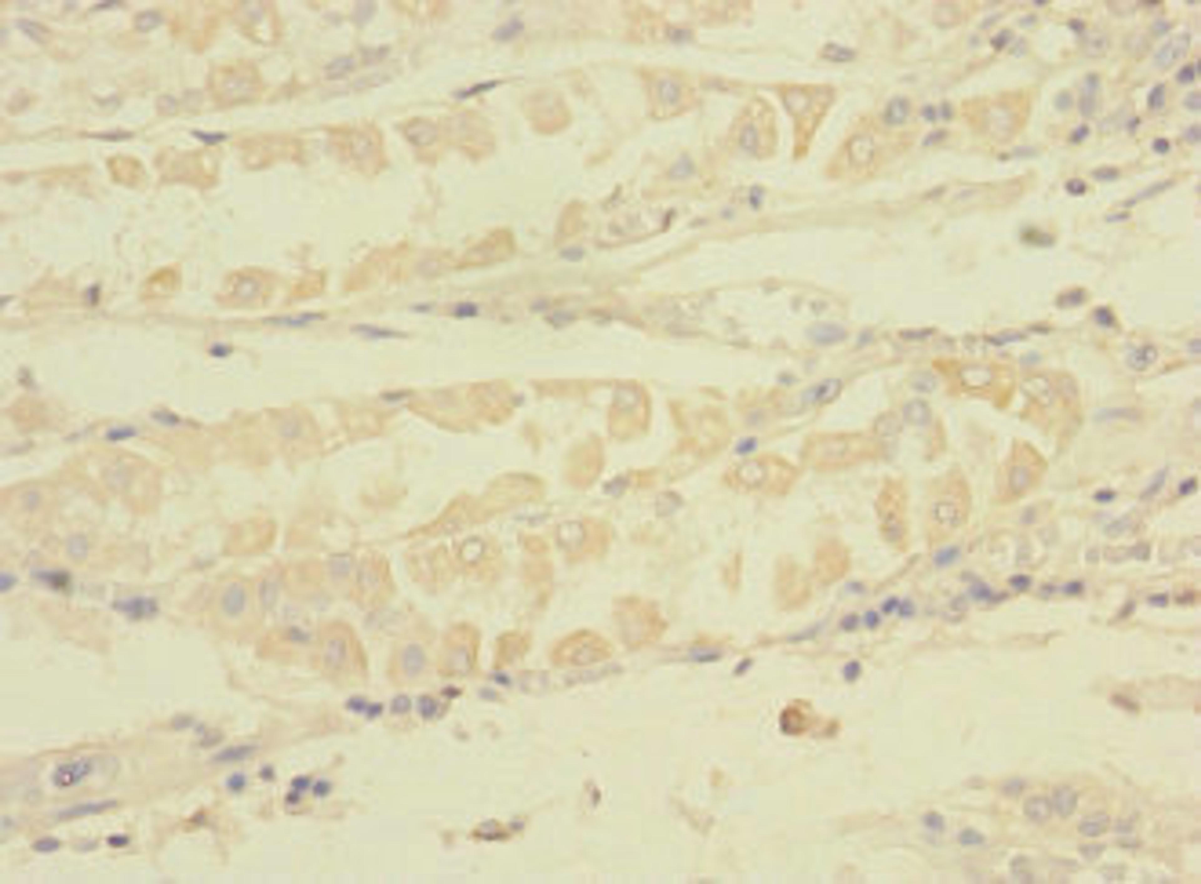 Immunohistochemistry of paraffin-embedded human gastric cancer using CSB-PA839859LA01HU at dilution of 1:100