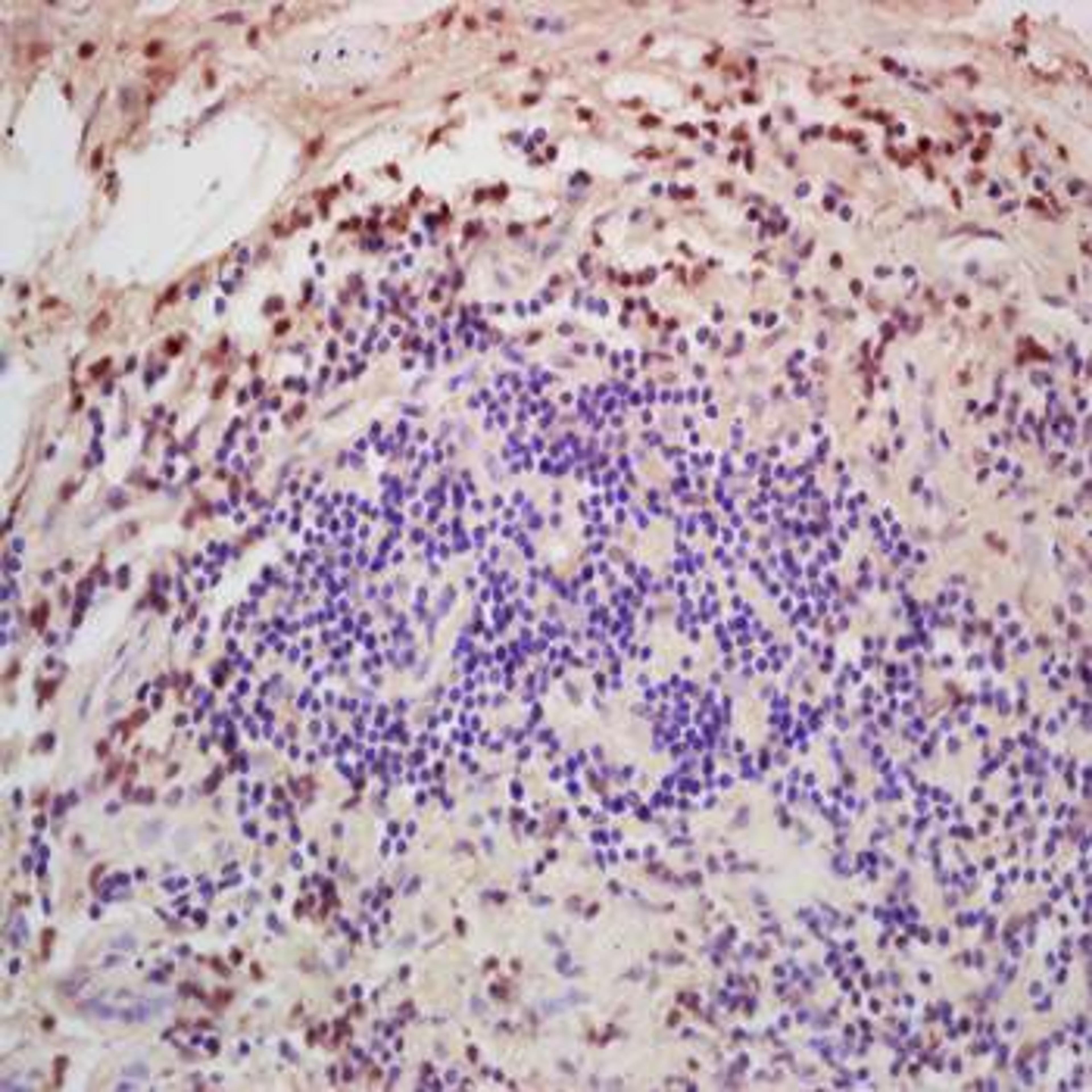 IHC-P of human colon carcinoma tissue using DGAT1 antibody