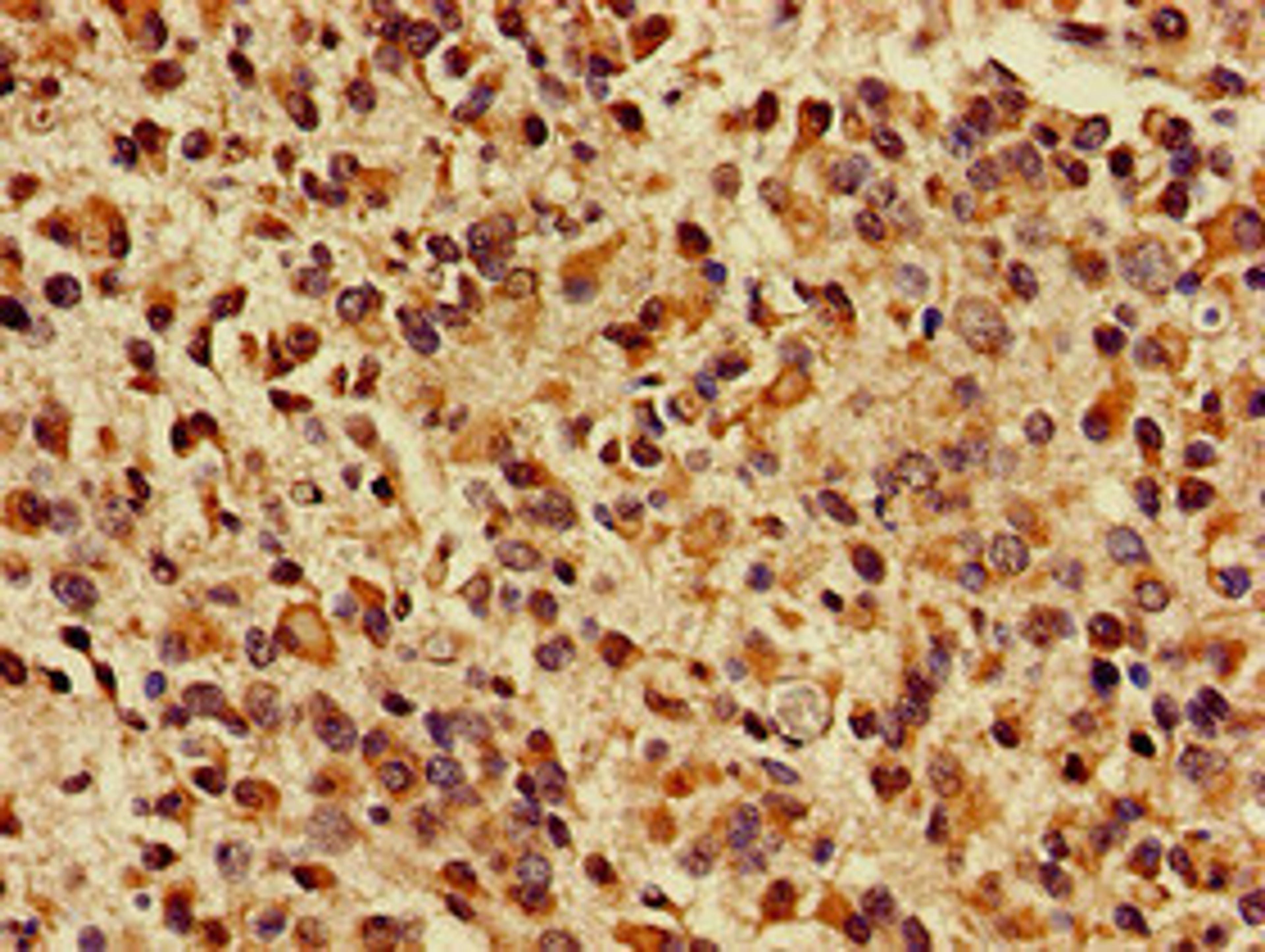 Immunohistochemistry of paraffin-embedded human glioma using CSB-PA865208LA01HU at dilution of 1:100