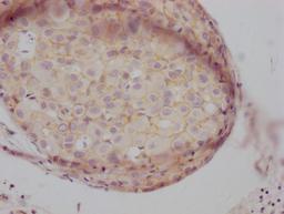 IHC image of CSB-RA155605A0HU diluted at 1:100 and staining in paraffin-embedded human breast cancer performed on a Leica BondTM system. After dewaxing and hydration, antigen retrieval was mediated by high pressure in a citrate buffer (pH 6.0). Section was blocked with 10% normal goat serum 30min at RT. Then primary antibody (1% BSA) was incubated at 4℃ overnight. The primary is detected by a Goat anti-rabbit IgG polymer labeled by HRP and visualized using 0.05% DAB.
