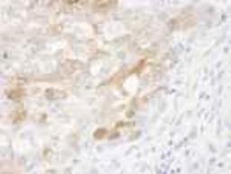 Immunohistochemistry-Paraffin: CRABP2 Antibody [NB100-2590] - FFPE section of human breast adenocarcinoma.  Affinity purified rabbit anti-CRABP2 used at a dilution of 1:500.