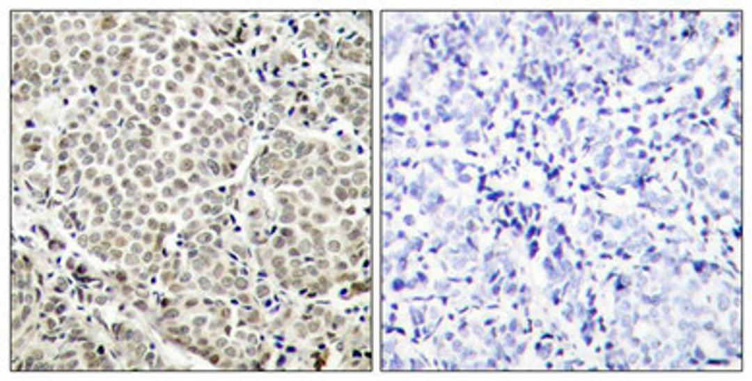 Immunohistochemical analysis of paraffin-embedded human breast carcinoma tissue using NFkB-p65(Phospho-Ser529) Antibody(left) or the same antibody preincubated with blocking peptide(right).