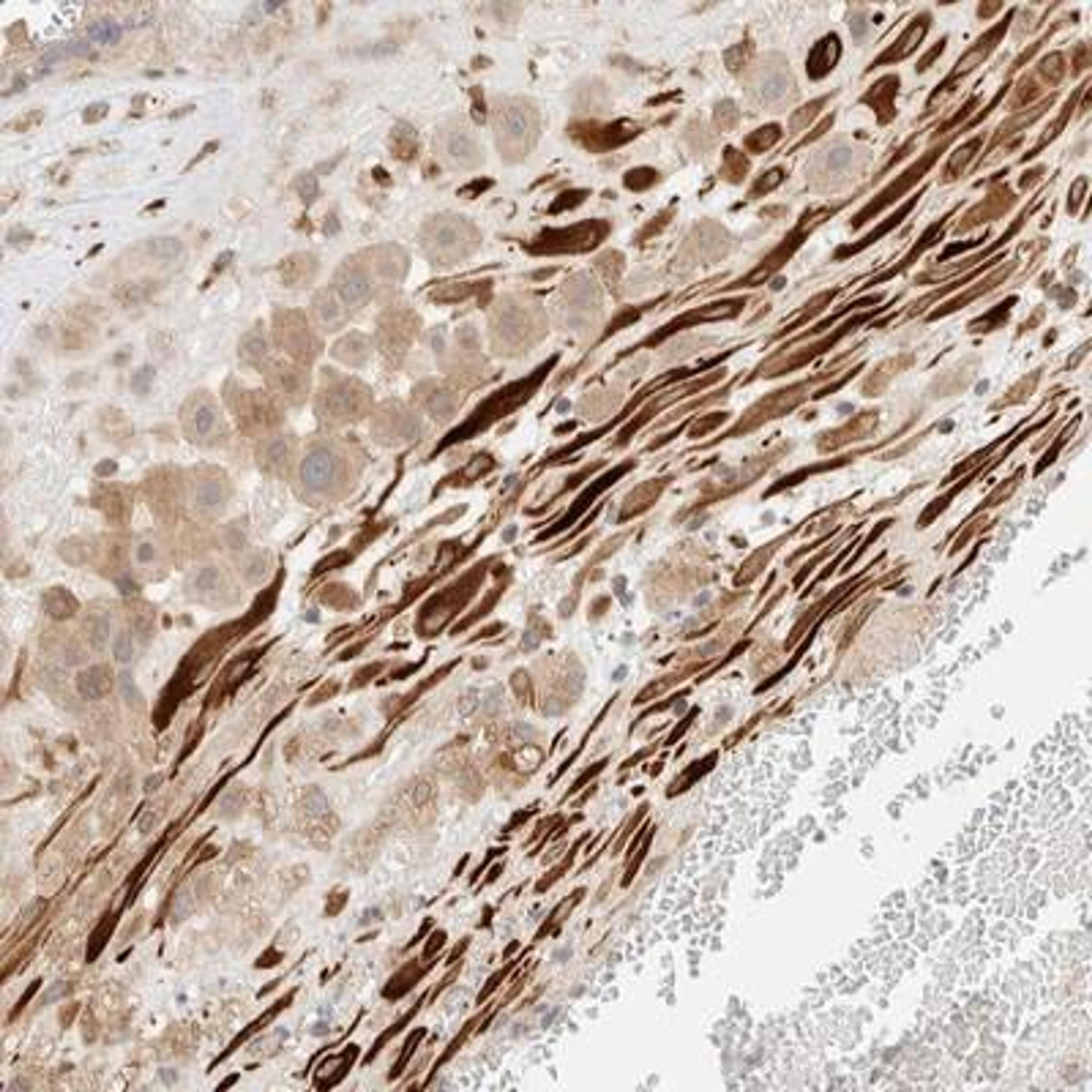 Immunohistochemistry: FAT1 Antibody [NBP1-84565] - Staining of human placenta shows strong cytoplasmic positivity in Decidual cells.