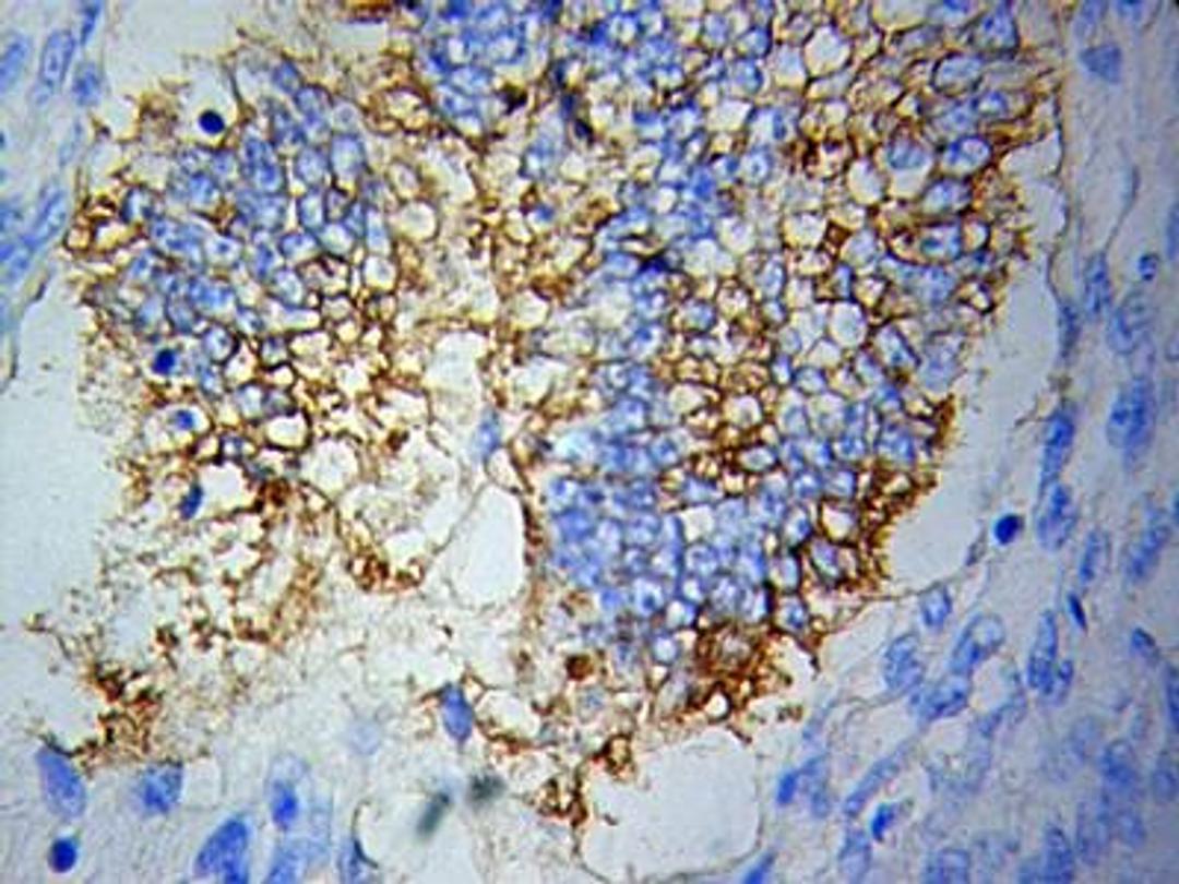 Immunohistochemical analysis of formalin fixed and paraffin-embedded Lymphoma tissue using TBRG4 antibody