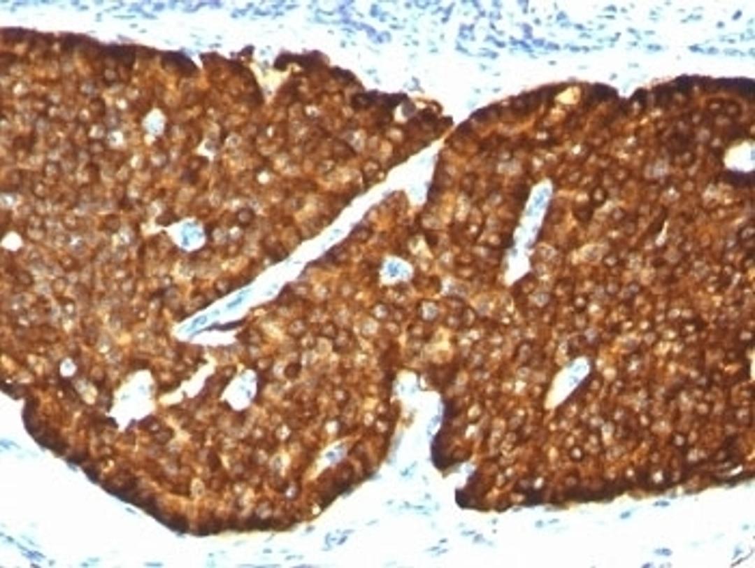 Formalin-fixed, paraffin-embedded human pheochromocytoma stained with Chromogranin A antibody (CGA/413)