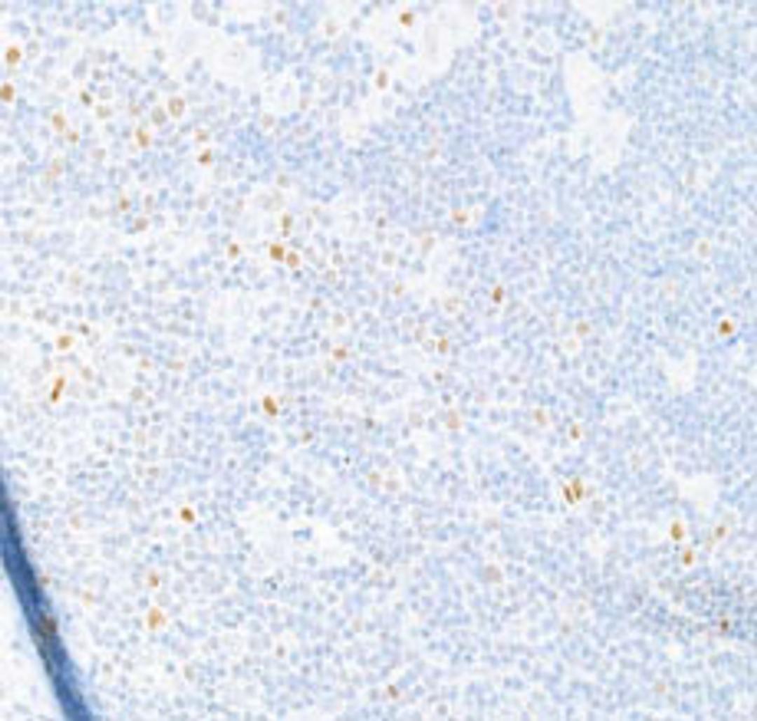 Detection of human T-bet/TBX21 in FFPE Hodgkin's lymphoma by IHC.