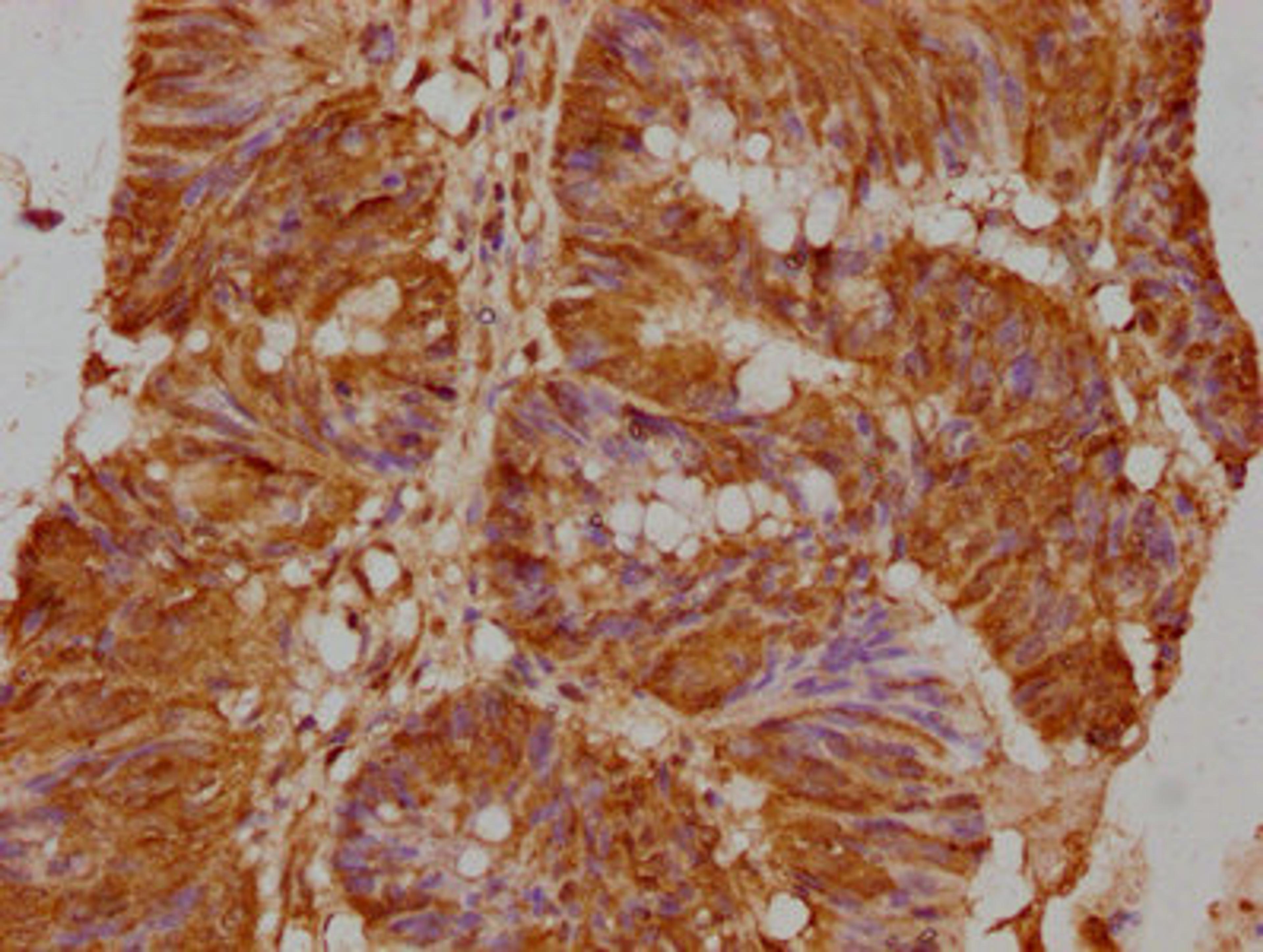 IHC image of CSB-PA009600LA01HU diluted at 1:500 and staining in paraffin-embedded human colon cancer performed on a Leica BondTM system. After dewaxing and hydration, antigen retrieval was mediated by high pressure in a citrate buffer (pH 6.0). Section was blocked with 10% normal goat serum 30min at RT. Then primary antibody (1% BSA) was incubated at 4°C overnight. The primary is detected by a biotinylated secondary antibody and visualized using an HRP conjugated SP system.