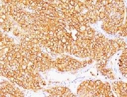 Formalin-fixed, paraffin-embedded human renal cell carcinoma stained with CA9 antibody (SPM314).