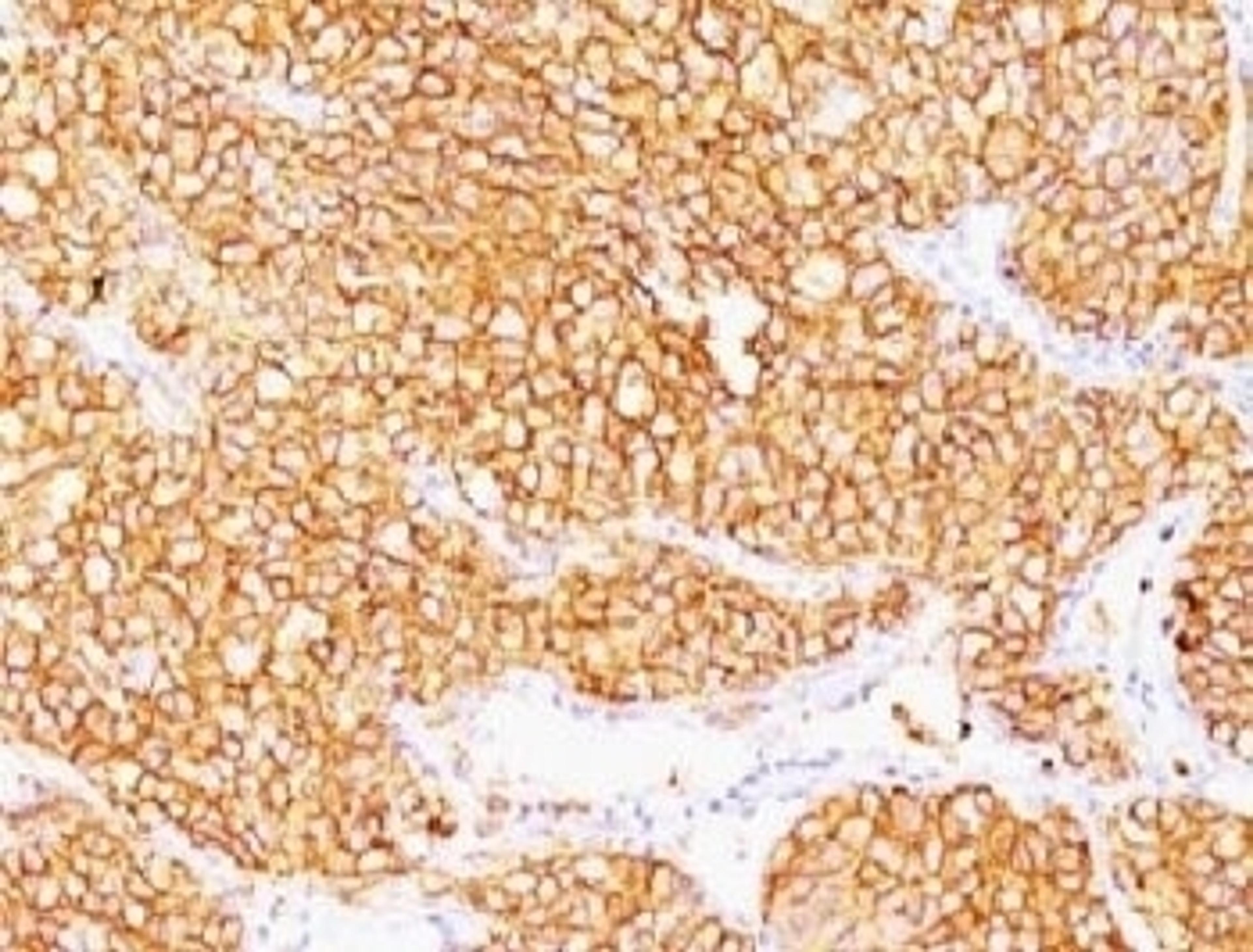 Formalin-fixed, paraffin-embedded human renal cell carcinoma stained with CA9 antibody (SPM314).