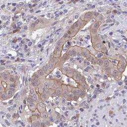 Immunohistochemistry: C5orf24 Antibody [NBP2-31686] - stomach cancer