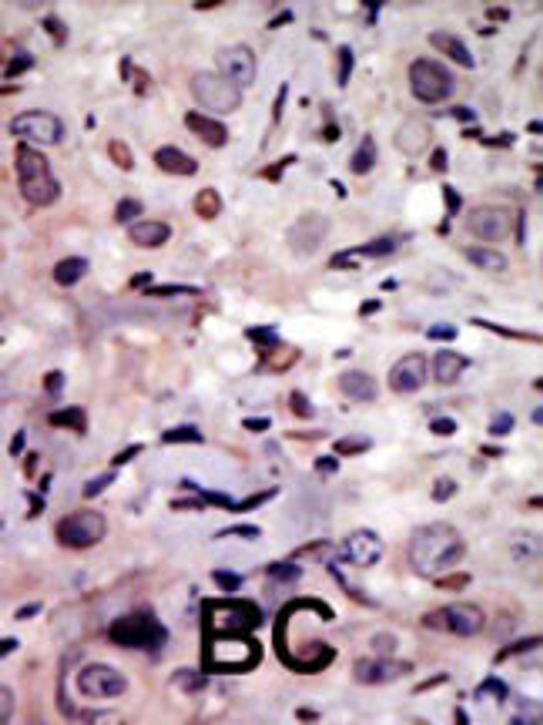 Formalin-fixed and paraffin-embedded human cancer tissue reacted with the primary antibody, which was peroxidase-conjugated to the secondary antibody, followed by AEC staining. BC = breast carcinoma; HC = hepatocarcinoma.