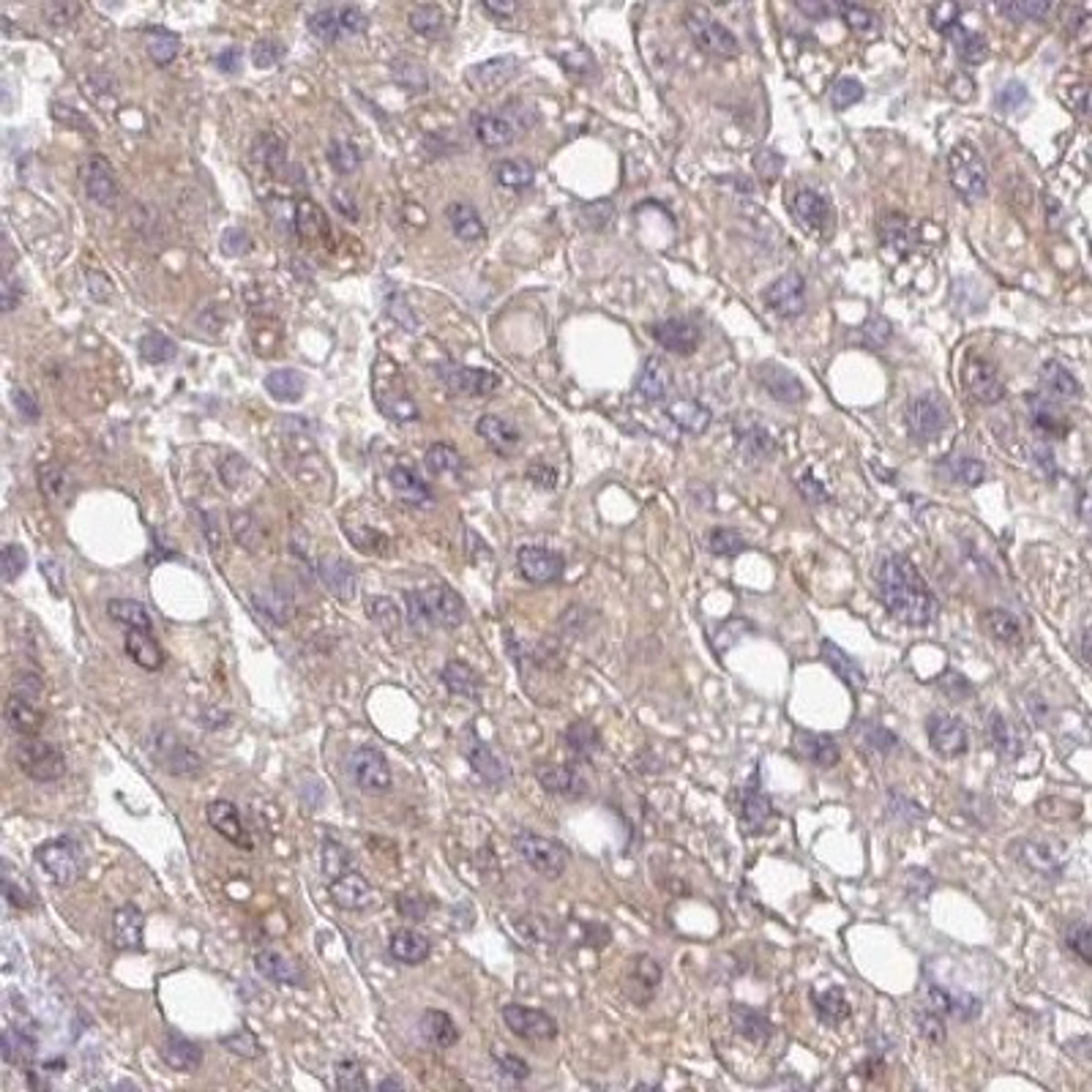 Immunohistochemistry: NDUFB2 Antibody [NBP2-31908] - liver cancer