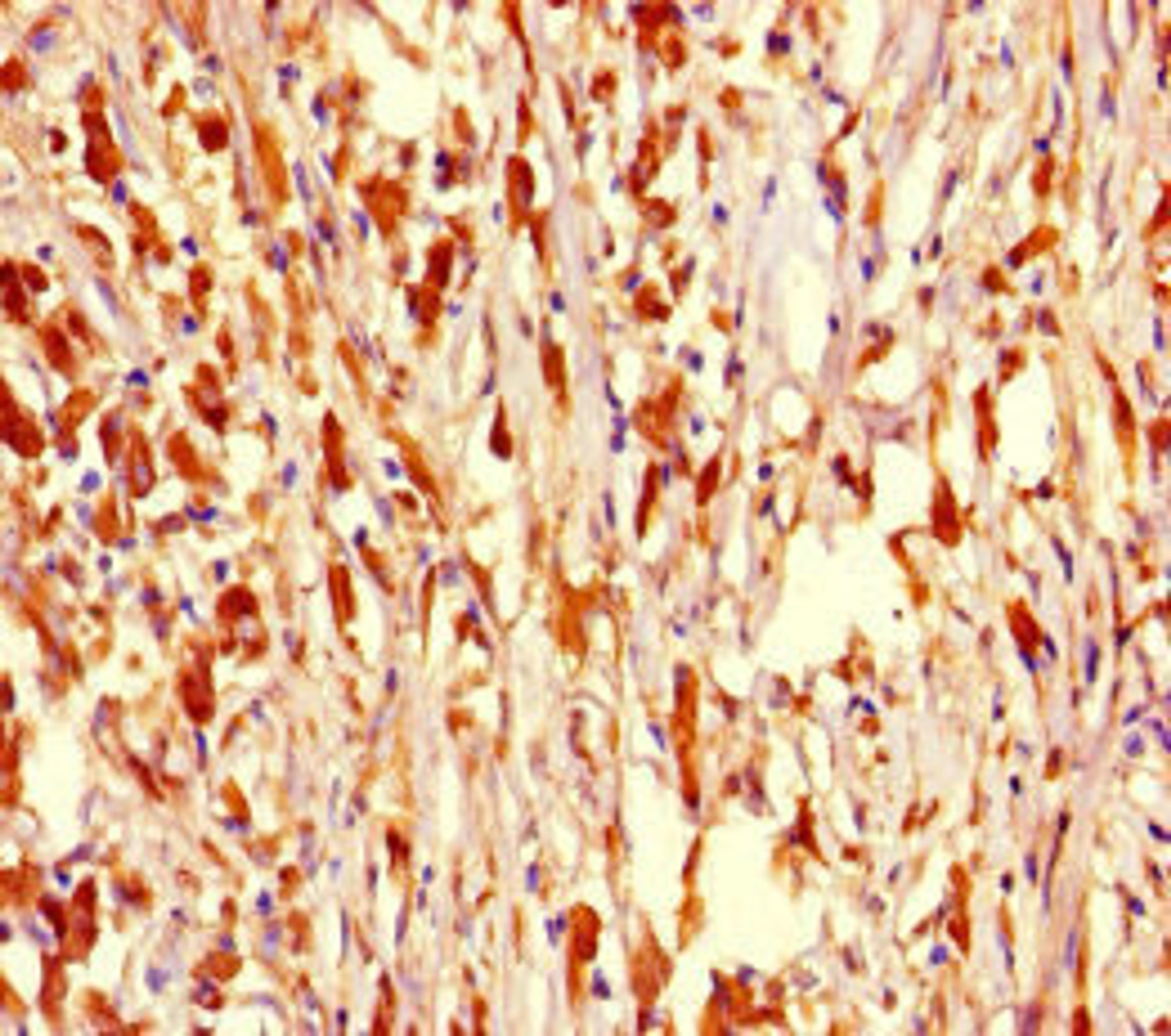 Immunohistochemistry of paraffin-embedded human melanoma using CSB-PA016045HA01HU at dilution of 1:100