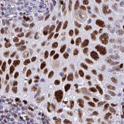 Immunohistochemistry: ZNF586 Antibody [NBP2-31839] - cervical cancer